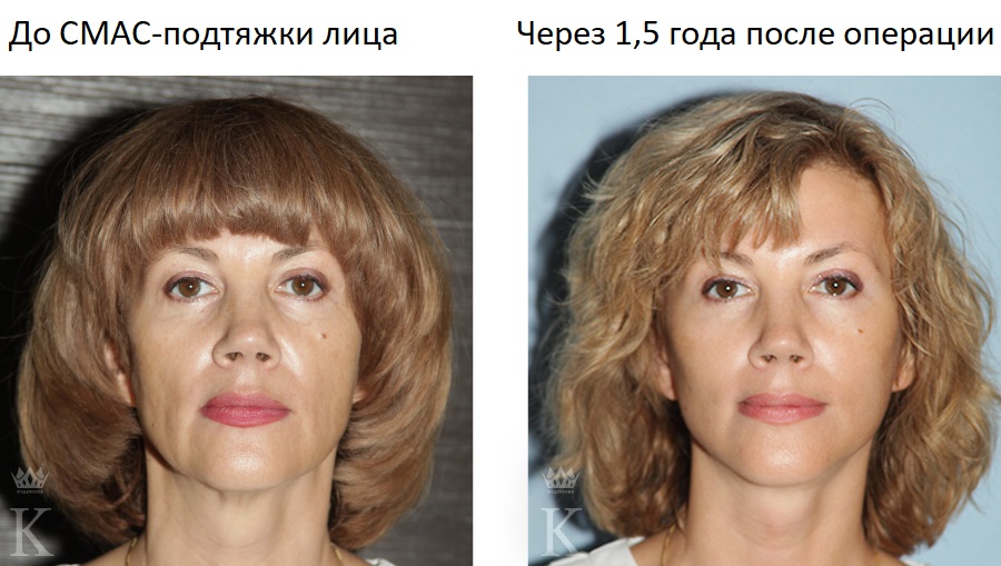 На фото: моя пациентка Алла - первый участник проекта «Поверни время вспять!»