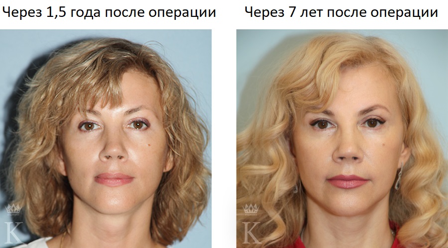 На фото: моя пациентка Алла - первый участник проекта «Поверни время вспять!»