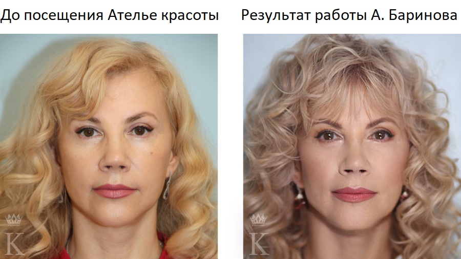 На фото: моя пациентка Алла - первый участник проекта «Поверни время вспять!»