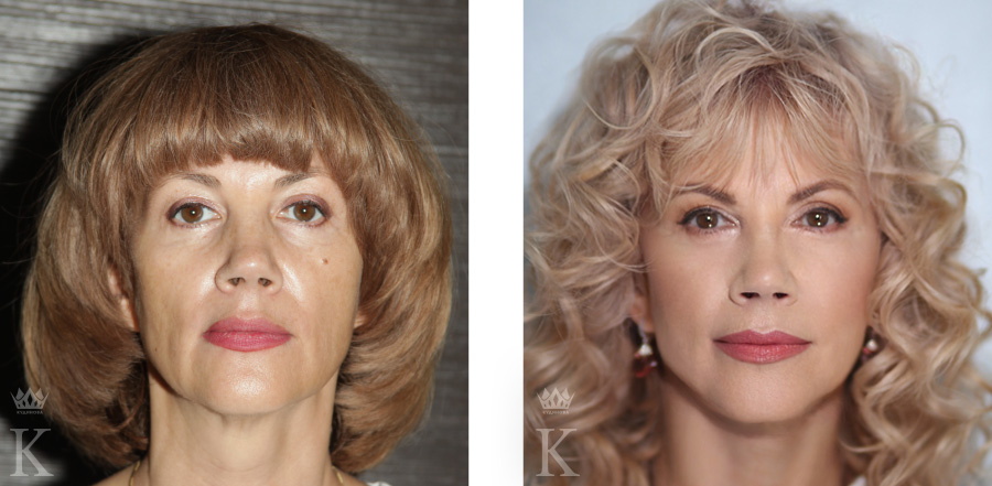 На фото: моя пациентка Алла - первый участник проекта «Поверни время вспять!»